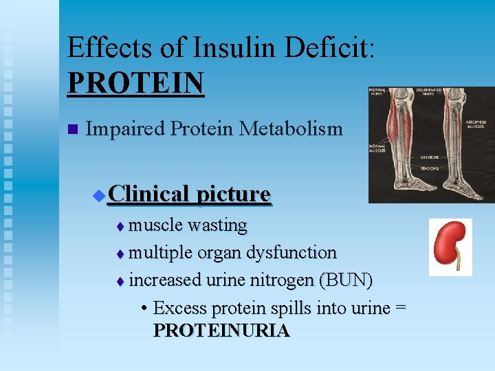 Effects of Insulin Deficit: PROTEIN n Impaired Protein Metabolism Clinical picture u muscle wasting
