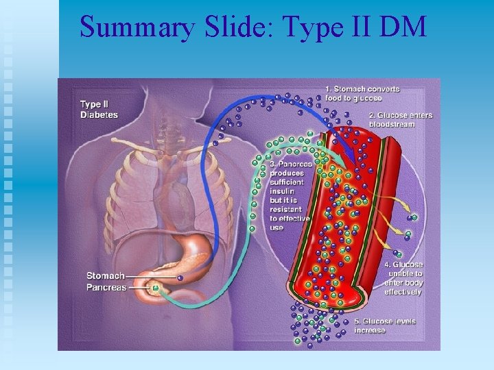 Summary Slide: Type II DM 