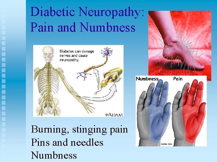 Diabetic Neuropathy: Pain and Numbness Burning, stinging pain Pins and needles Numbness 