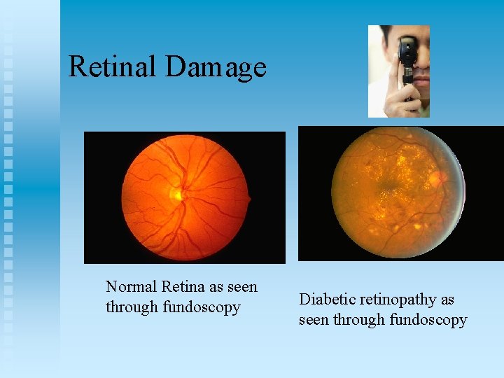 Retinal Damage Normal Retina as seen through fundoscopy Diabetic retinopathy as seen through fundoscopy