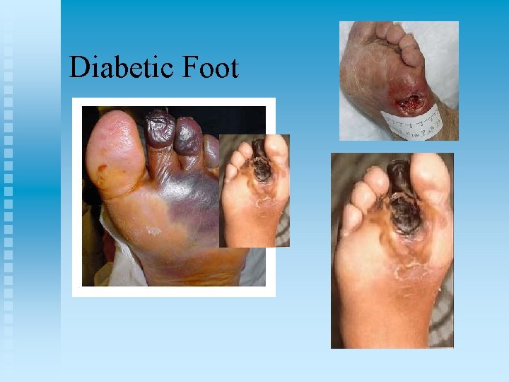 Diabetic Foot 