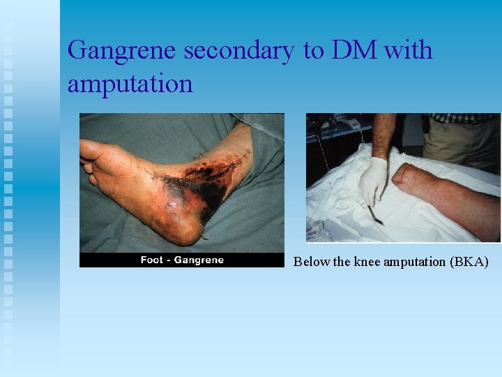 Gangrene secondary to DM with amputation Below the knee amputation (BKA) 