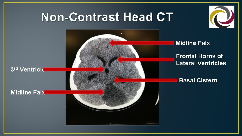 Non-Contrast Head CT Midline Falx 3 rd Ventricle Frontal Horns of Lateral Ventricles Basal