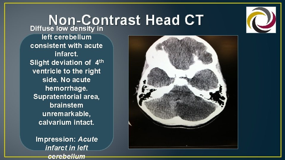 Non-Contrast Head CT Diffuse low density in left cerebellum consistent with acute infarct. Slight