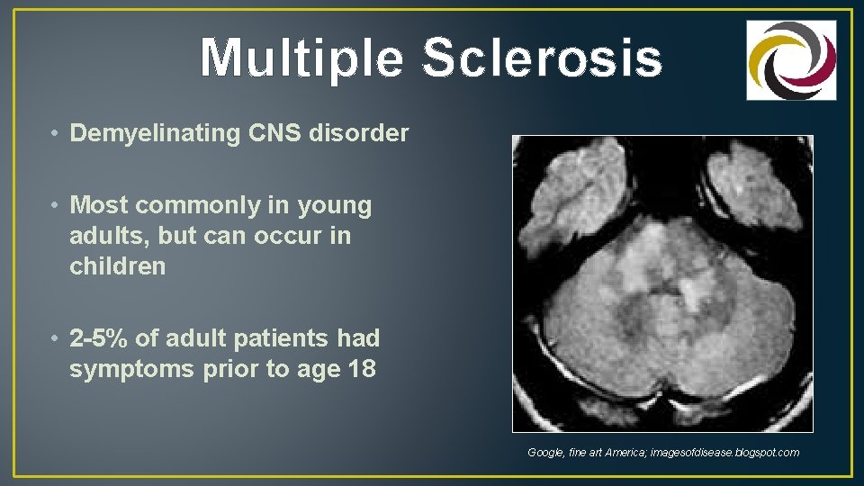 Multiple Sclerosis • Demyelinating CNS disorder • Most commonly in young adults, but can