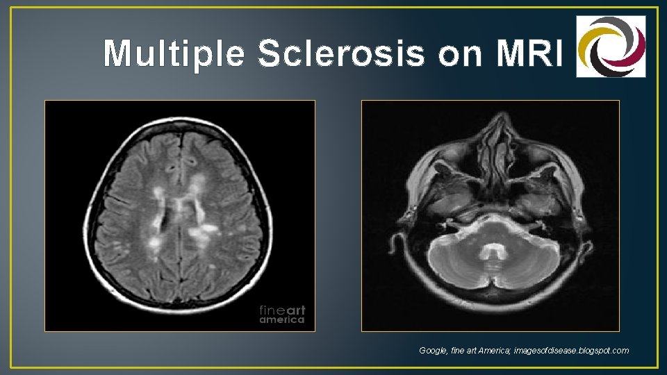 Multiple Sclerosis on MRI Google, fine art America; imagesofdisease. blogspot. com 