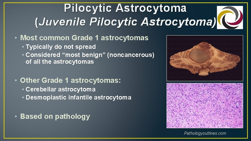 Pilocytic Astrocytoma (Juvenile Pilocytic Astrocytoma) • Most common Grade 1 astrocytomas • Typically do