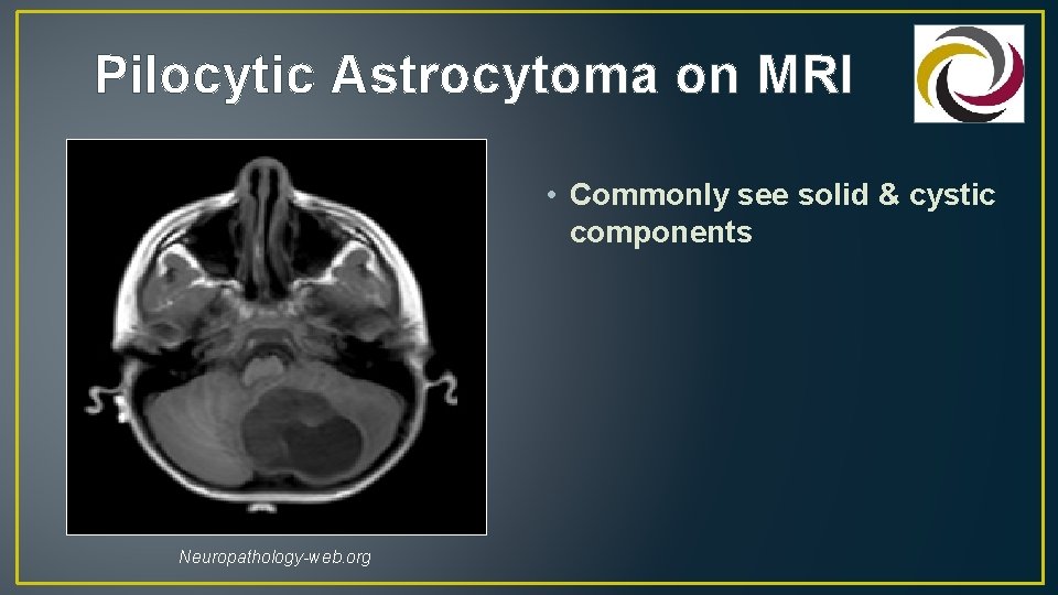 Pilocytic Astrocytoma on MRI • Commonly see solid & cystic components Neuropathology-web. org 