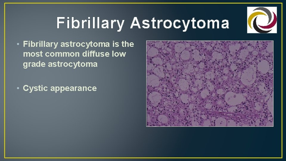 Fibrillary Astrocytoma • Fibrillary astrocytoma is the most common diffuse low grade astrocytoma •