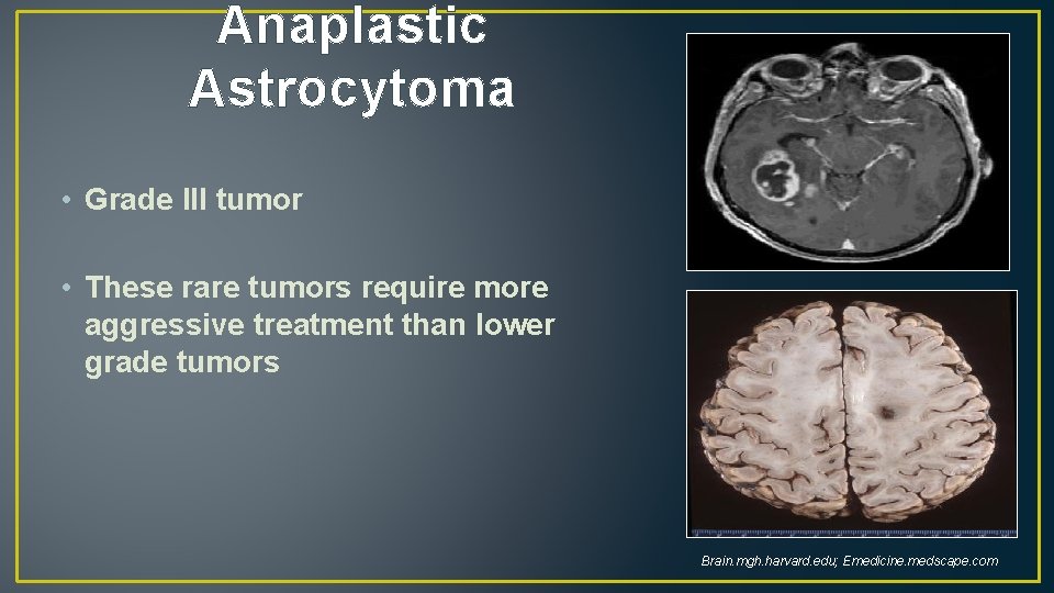 Anaplastic Astrocytoma • Grade III tumor • These rare tumors require more aggressive treatment