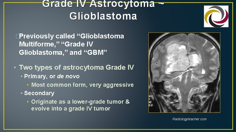 Grade IV Astrocytoma ~ Glioblastoma �Previously called “Glioblastoma Multiforme, ” “Grade IV Glioblastoma, ”