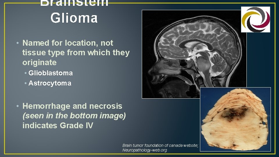 Brainstem Glioma • Named for location, not tissue type from which they originate •