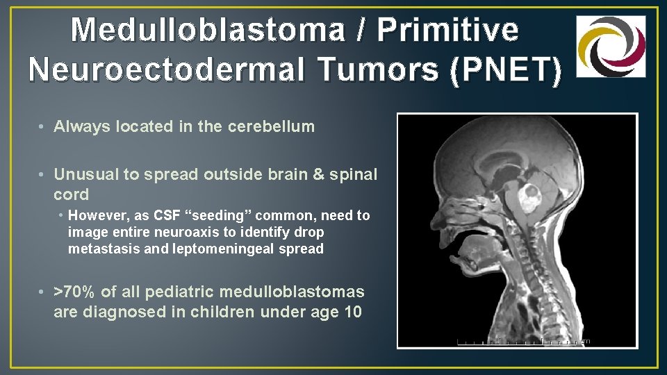 Medulloblastoma / Primitive Neuroectodermal Tumors (PNET) • Always located in the cerebellum • Unusual