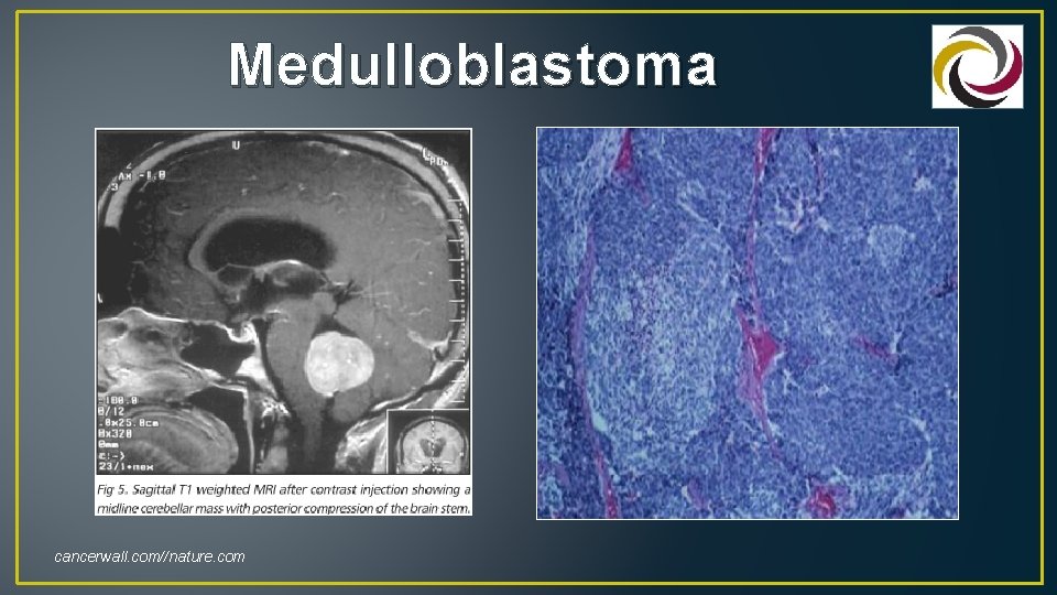 Medulloblastoma cancerwall. com//nature. com 