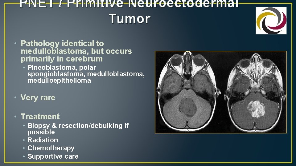 PNET / Primitive Neuroectodermal Tumor • Pathology identical to medulloblastoma, but occurs primarily in