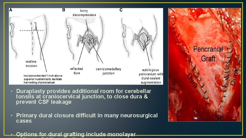  • Duraplasty provides additional room for cerebellar tonsils at craniocervical junction, to close