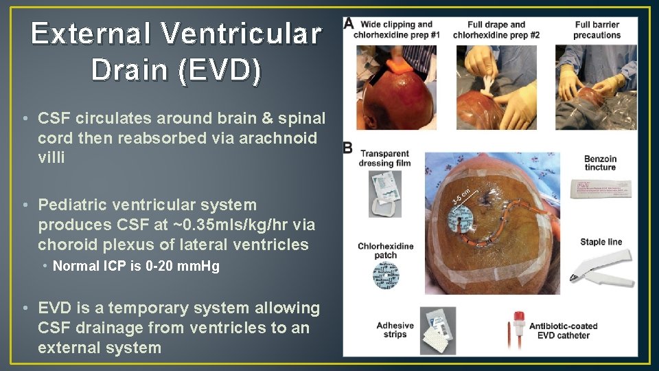 External Ventricular Drain (EVD) • CSF circulates around brain & spinal cord then reabsorbed
