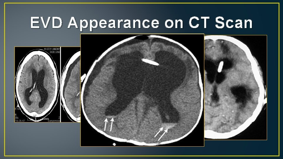 EVD Appearance on CT Scan 