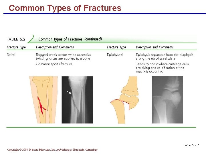 Common Types of Fractures Table 6. 2. 2 Copyright © 2004 Pearson Education, Inc.