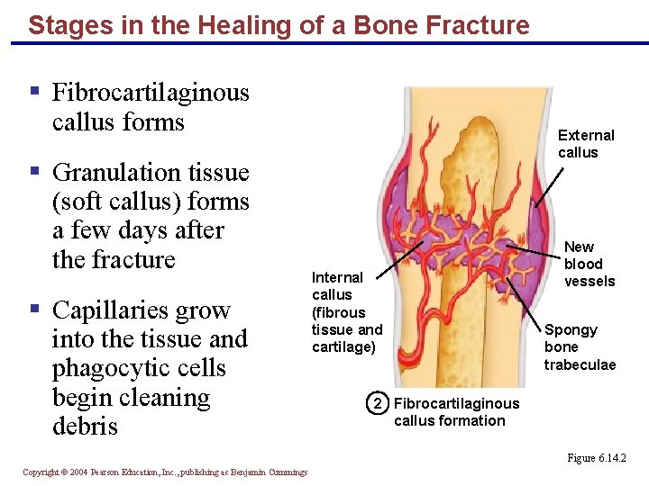 Stages in the Healing of a Bone Fracture § Fibrocartilaginous callus forms § Granulation