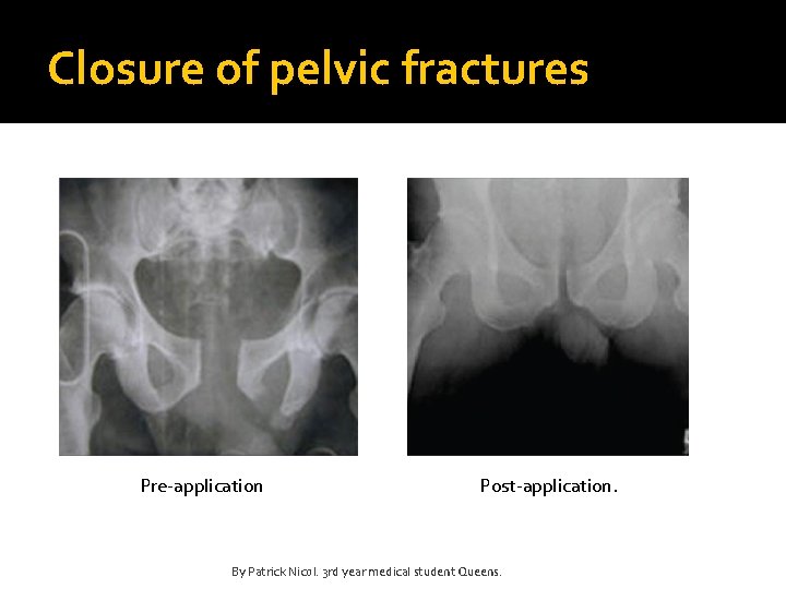 Closure of pelvic fractures Pre-application Post-application. By Patrick Nicol. 3 rd year medical student