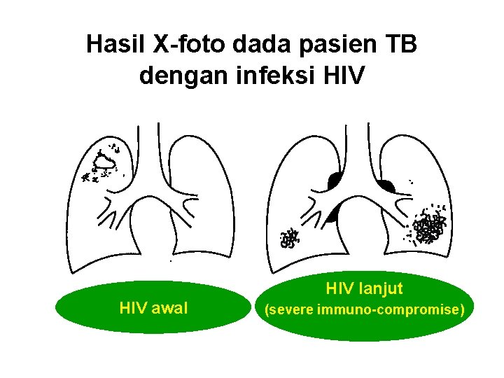 Hasil X-foto dada pasien TB dengan infeksi HIV lanjut HIV awal (severe immuno-compromise) 