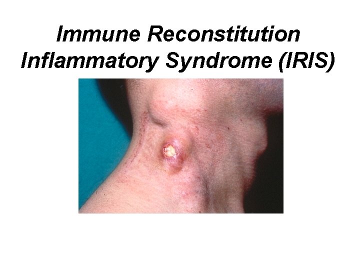 Immune Reconstitution Inflammatory Syndrome (IRIS) 