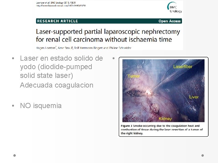 • Laser en estado solido de yodo (diodide-pumped solid state laser) Adecuada coagulacion • Laser en estado solido de yodo (diodide-pumped solid state laser) Adecuada coagulacion