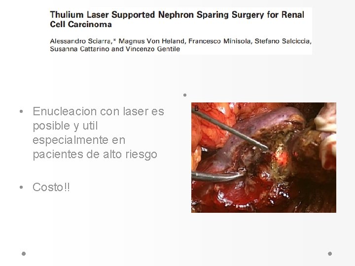 • • Enucleacion con laser es posible y util especialmente en pacientes de • • Enucleacion con laser es posible y util especialmente en pacientes de