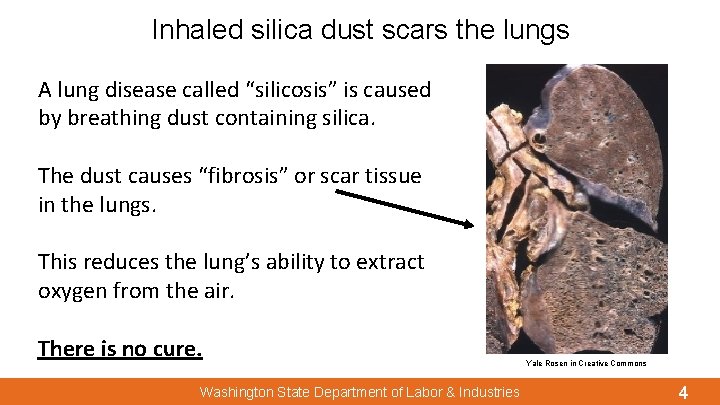 Inhaled silica dust scars the lungs A lung disease called “silicosis” is caused by
