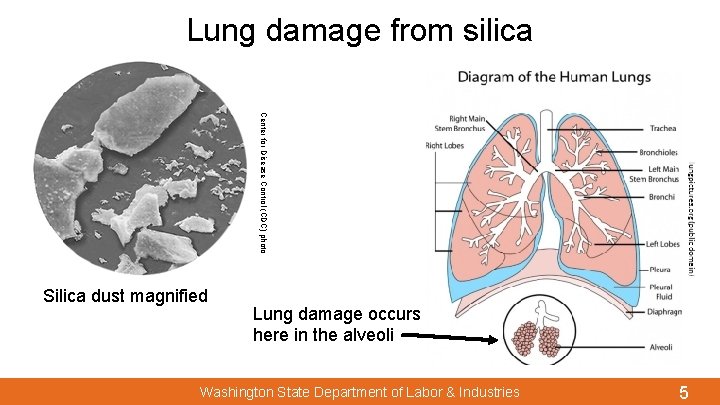 Lung damage from silica Center for Disease Control (CDC) photo Silica dust magnified Lung