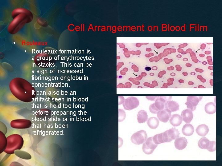 Cell Arrangement on Blood Film • Rouleaux formation is a group of erythrocytes in