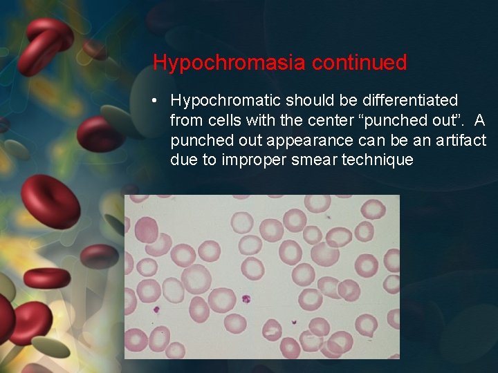 Hypochromasia continued • Hypochromatic should be differentiated from cells with the center “punched out”.