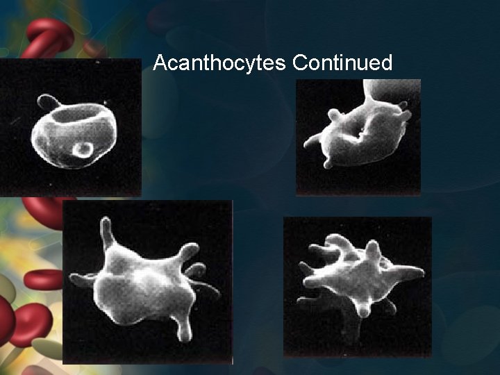 Acanthocytes Continued 