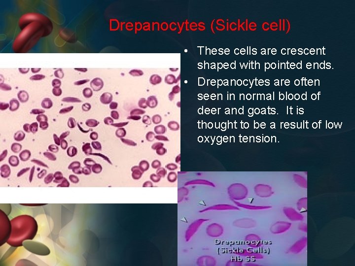 Drepanocytes (Sickle cell) • These cells are crescent shaped with pointed ends. • Drepanocytes