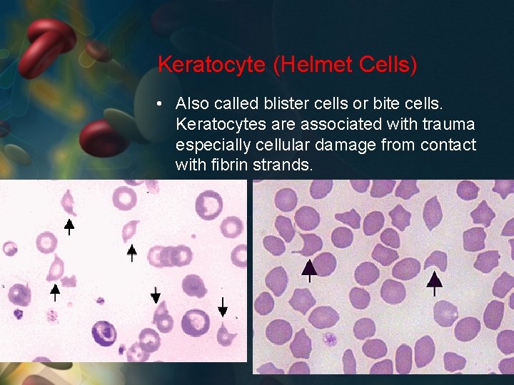 Keratocyte (Helmet Cells) • Also called blister cells or bite cells. Keratocytes are associated