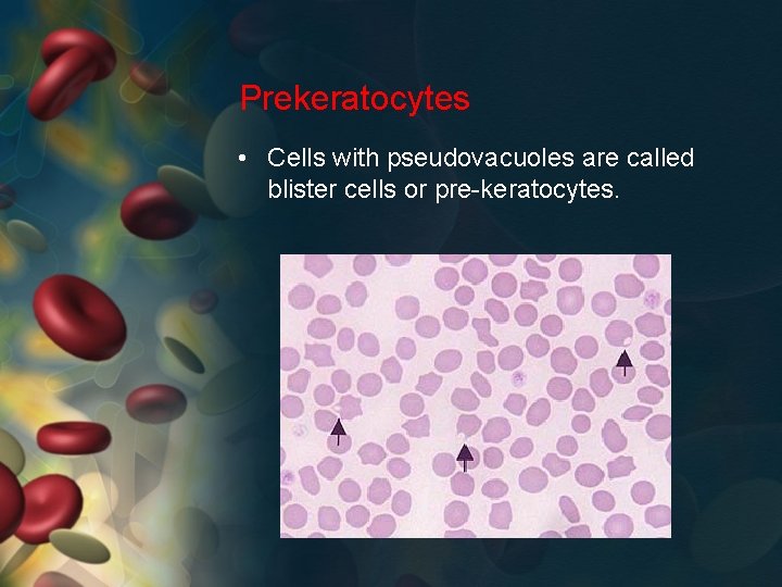 Prekeratocytes • Cells with pseudovacuoles are called blister cells or pre-keratocytes. 