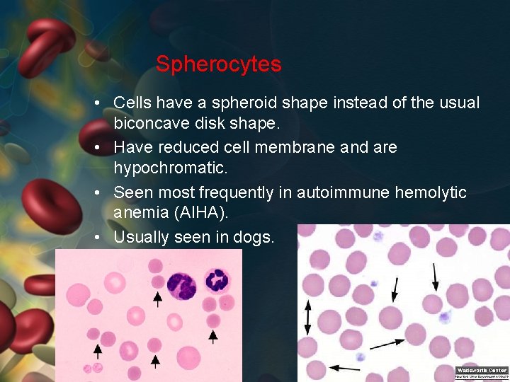 Spherocytes • Cells have a spheroid shape instead of the usual biconcave disk shape.