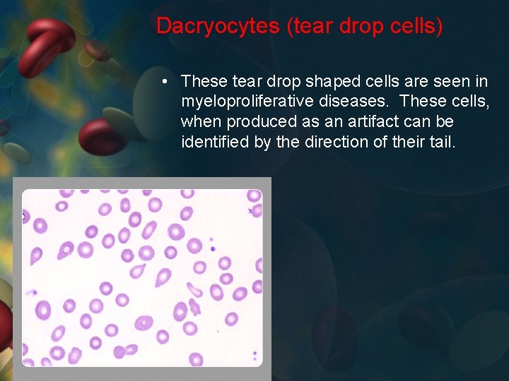 Dacryocytes (tear drop cells) • These tear drop shaped cells are seen in myeloproliferative