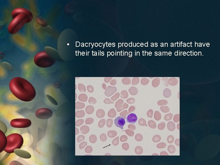  • Dacryocytes produced as an artifact have their tails pointing in the same