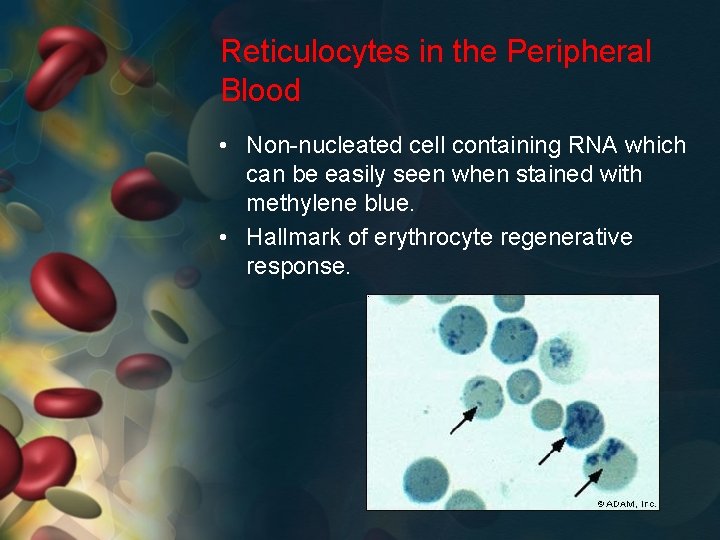 Reticulocytes in the Peripheral Blood • Non-nucleated cell containing RNA which can be easily