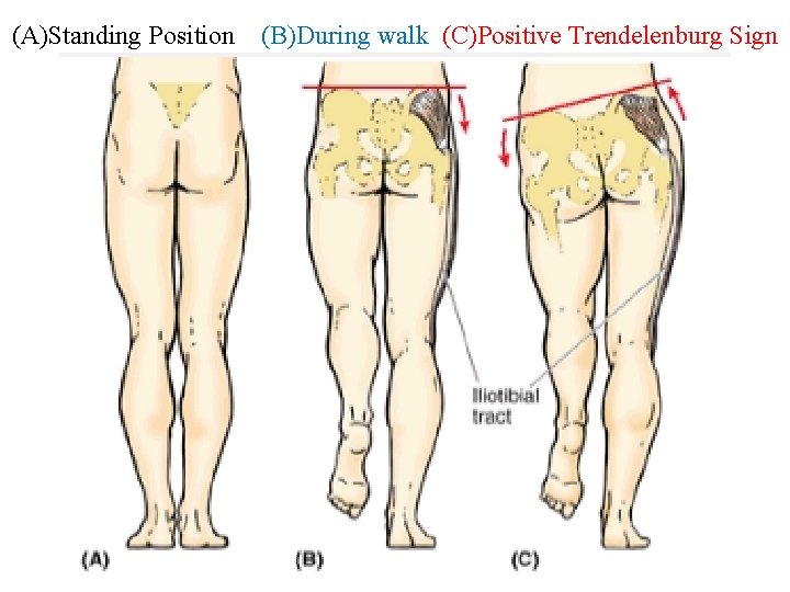 (A)Standing Position (B)During walk (C)Positive Trendelenburg Sign 