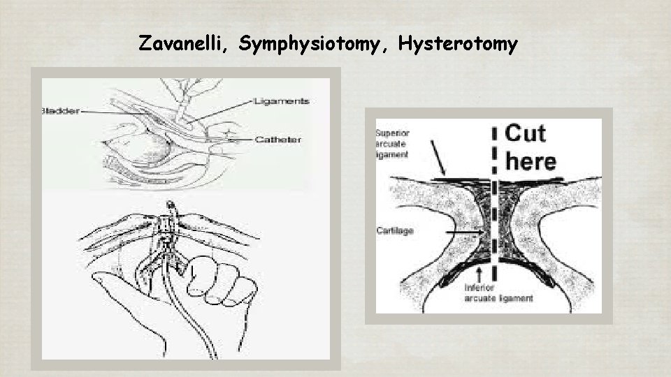 Zavanelli, Symphysiotomy, Hysterotomy 