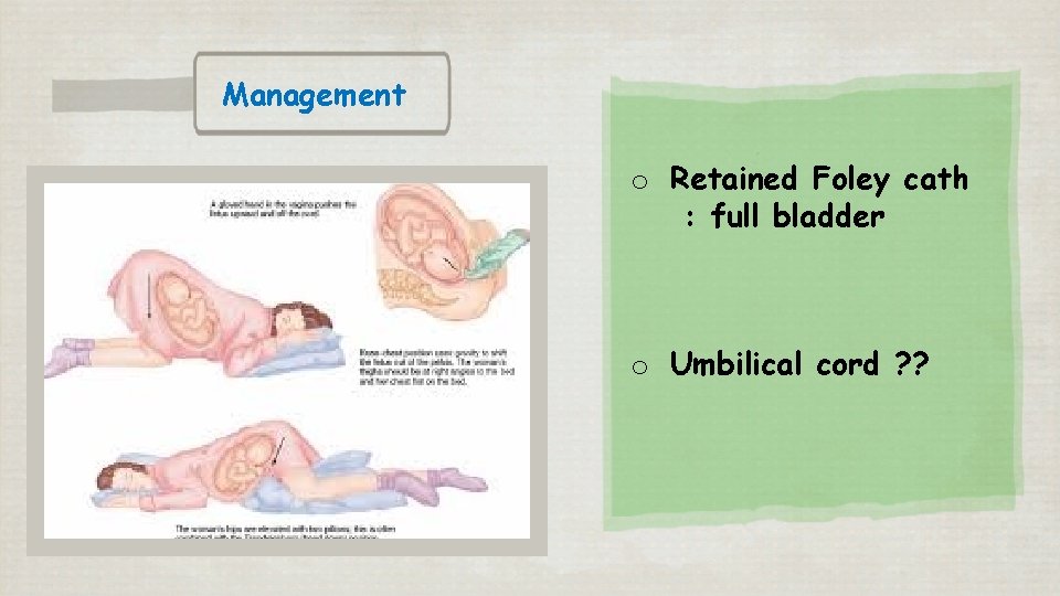 Management o Retained Foley cath : full bladder o Umbilical cord ? ? 