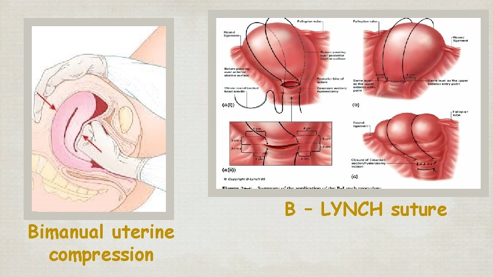 Bimanual uterine compression B – LYNCH suture 