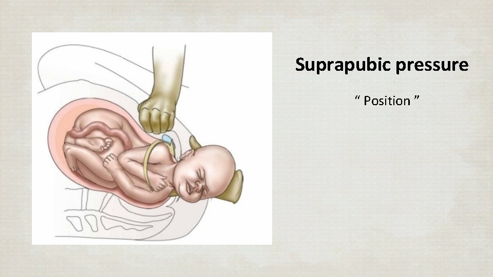 Suprapubic pressure “ Position ” 
