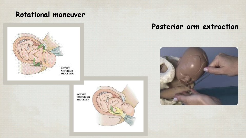 Rotational maneuver Posterior arm extraction 