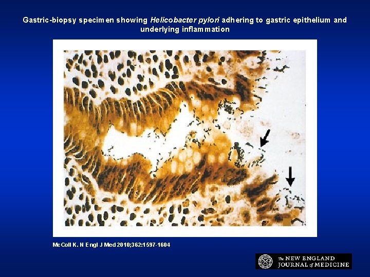 Gastric-biopsy specimen showing Helicobacter pylori adhering to gastric epithelium and underlying inflammation Mc. Coll