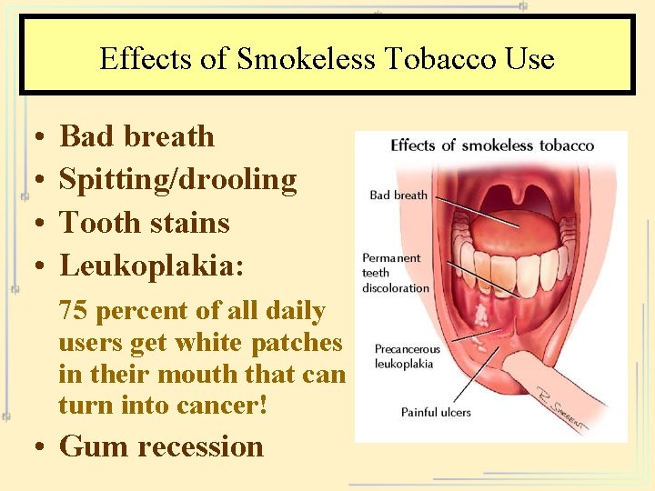 Effects of Smokeless Tobacco Use • • Bad breath Spitting/drooling Tooth stains Leukoplakia: 75