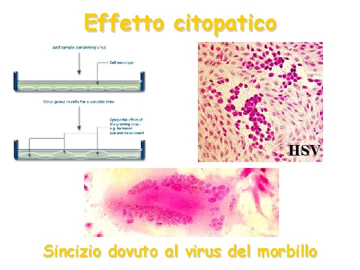 Effetto citopatico HSV Sincizio dovuto al virus del morbillo 